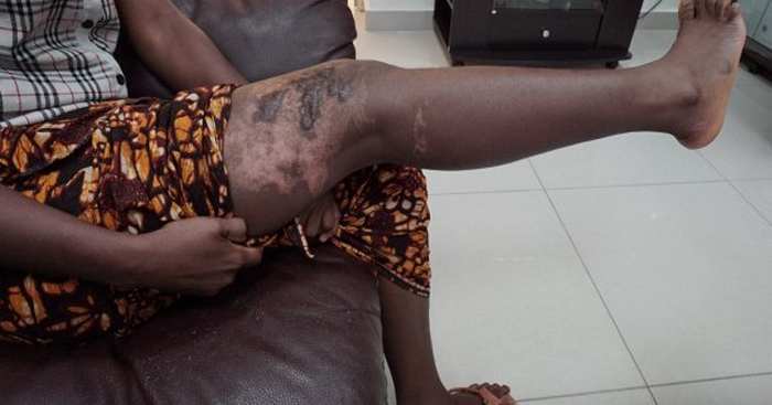 Querelles domestiques : Rosalie Faye ébouillante sa belle-sœur à Pikine Icotaf