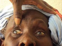 NEGLIGENCE DE LA SANTE OCULAIRE AU SENEGAL:  Il y a près de 165 000 aveugles