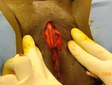 Figure 4. Résection de la cicatrice de la mutilation et mise en évidence du moignon clitoridien.