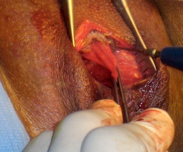 Figure 5. Libération du genou clitoridien.