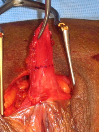 Figure 7. Moignon clitoridien avant résection des tissus cicatriciels.