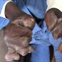 Lutte contre la lèpre : le Sénégal a fait des progrès