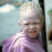 Sorcellerie: un enfant albinos amputé en Tanzanie