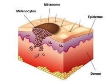 Les rayons de soleil, dangereux