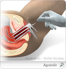 Du vinaigre pour détecter le cancer du col de l’utérus