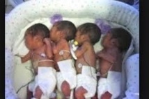 Ziguinchor : Une dame accouche de quadruplés, demande de l’aide !