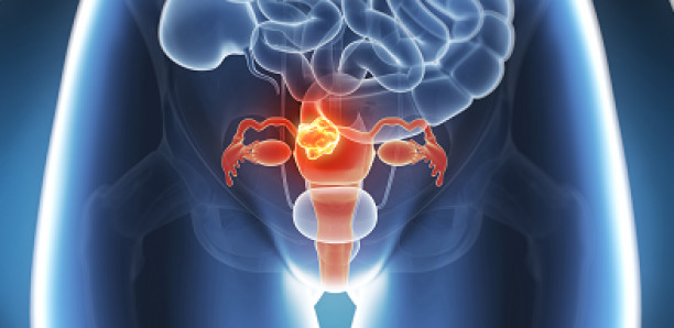 Au Sénégal, 3,2 millions de femmes risquent de développer un cancer du col de l’utérus (médecin)