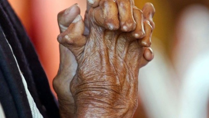 Sénégal: plus de 150 nouveaux cas de lèpres enregistrés en 2022 Sénégal: plus de 150 nouveaux cas de lèpres enregistrés en 2022