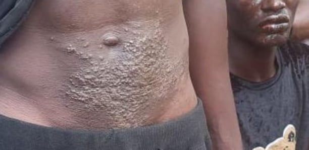 Guinée: une cinquantaine de pêcheurs atteints d'une mystérieuse maladie de peau, une commission de crise installée