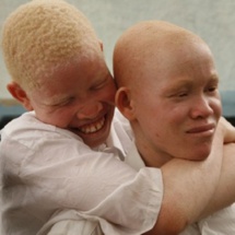 Nouvelle alarmante : 300 albinos au seuil de la mort dans les mois prochains Nouvelle alarmante : 300 albinos au seuil de la mort dans les mois prochains