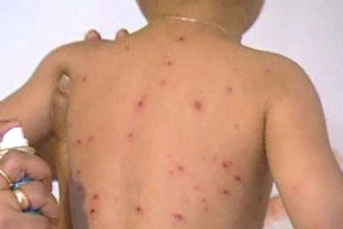 plusieurs cas de rougeole à Kédougou