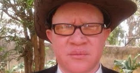 Les albinos ont la vie dure au Sénégal