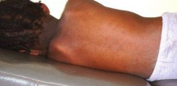 Plusieurs cas de rougeole signalés à Kédougou