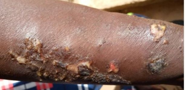 Maladie mystérieuse chez les pêcheurs : Les femmes de Ndayane ont trouvé le "remède