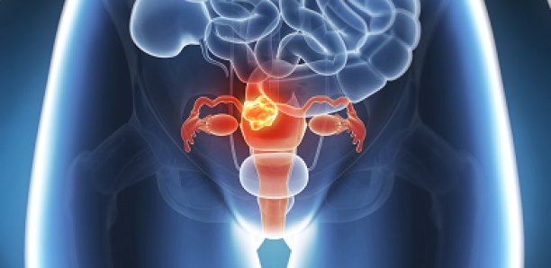 Au Sénégal, 3,2 millions de femmes risquent de développer un cancer du col de l’utérus (médecin)