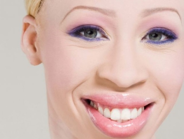 Miss Albinos débarque en Cote d’Ivoire