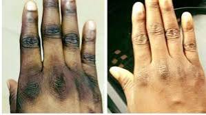 Dépigmentation (xéssal) : Dr Fatoumata Ly révèle un taux de mortalité alarmant