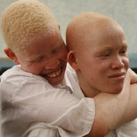 Nouvelle alarmante : 300 albinos au seuil de la mort dans les mois prochains