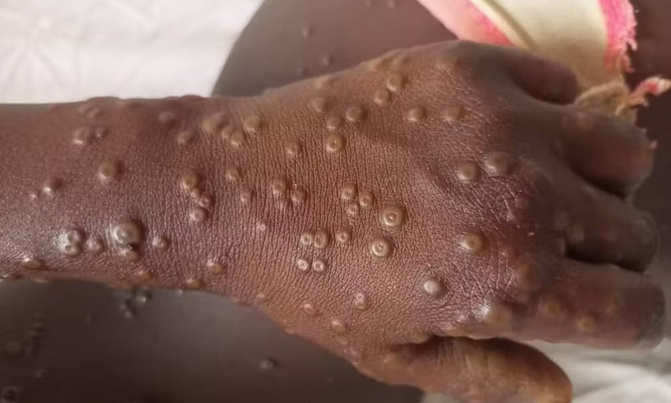 Alerte Santé : Le Sénégal enregistre un deuxième cas positif de la maladie Mpox