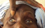 NEGLIGENCE DE LA SANTE OCULAIRE AU SENEGAL:  Il y a près de 165 000 aveugles