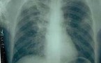 La tuberculose des enfants reste encore une épidémie cachée (ministère)
