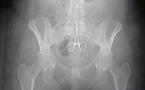ECOUTEZ. Xalass du 06 aout: Il vit avec une paire de ciseaux dans le ventre