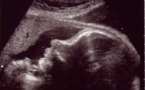 Camp Dial: l'enquête sur le foetus retrouvé piétine