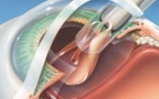 A Fatick, le coût de l’opération de la cataracte est réduit à 40 mille francs CFA (médecin)