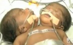 Inde : naissance d'un bébé à deux têtes