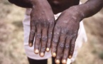 Variole du singe: l’OMS maintient l’alerte sanitaire maximale