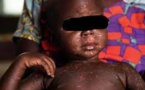 Santé: 7 cas de rougeole détectés dans la commune de Kaolack