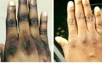 Dépigmentation (xéssal) : Dr Fatoumata Ly révèle un taux de mortalité alarmant