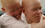 Nouvelle alarmante : 300 albinos au seuil de la mort dans les mois prochains