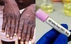 Le ministère de la Santé alerte : 277 cas confirmés, 22 décès liés à la fièvre de la vallée du Rift et de Mpox